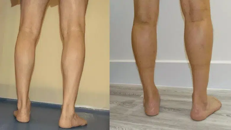 bilateral male calf augmentation before after