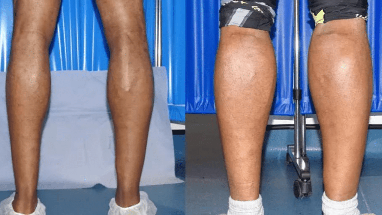 bilateral male calf implants before after 2