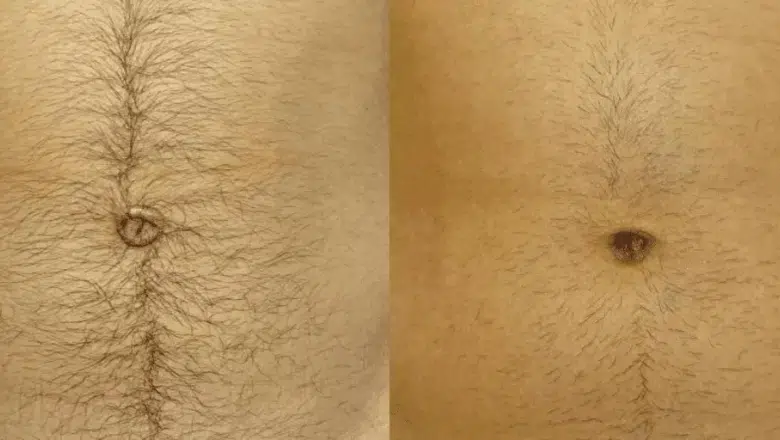 belly button before and after