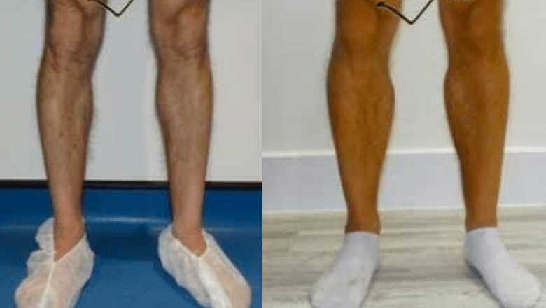 bilateral male calf implants before after 3