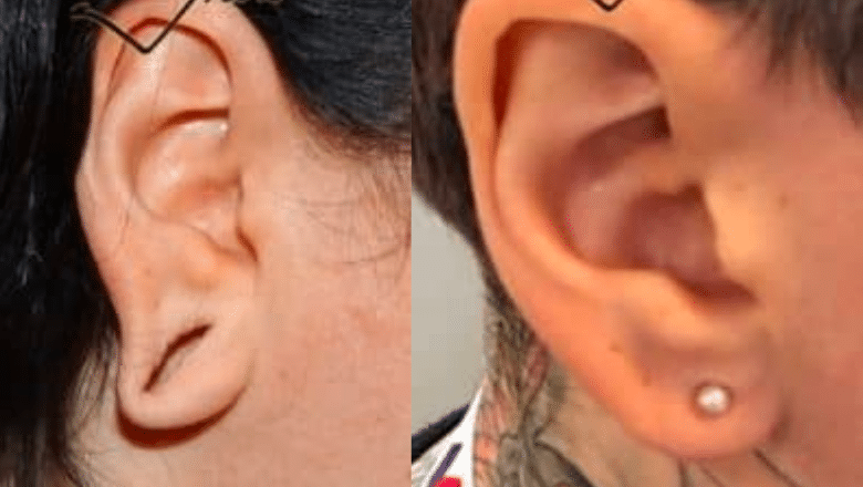 stretched earlobe repair before after 1