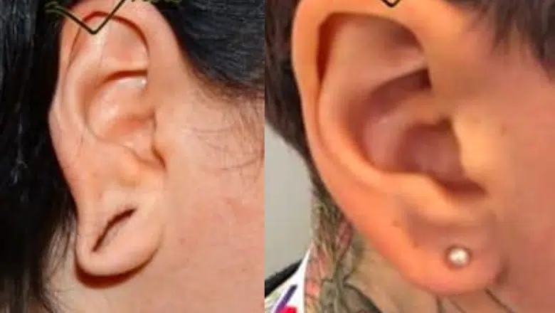 stretched earlobe repair before after 1