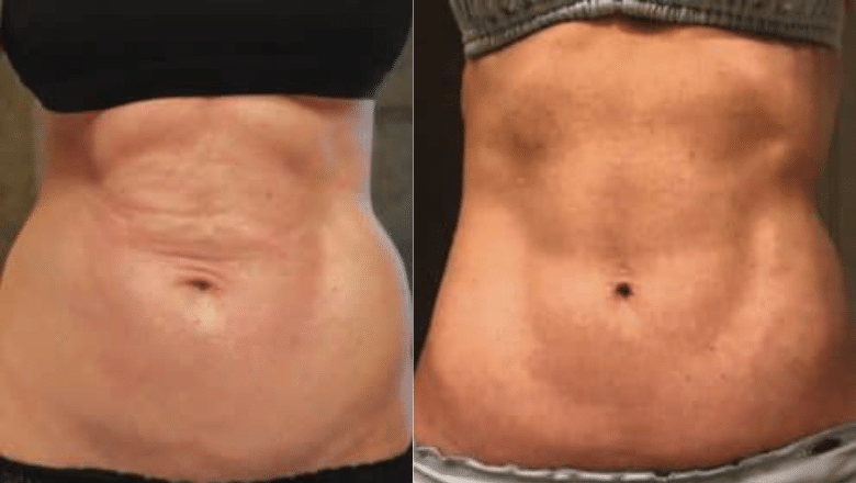 bodytite and Morpheus8 abdomen before after 2