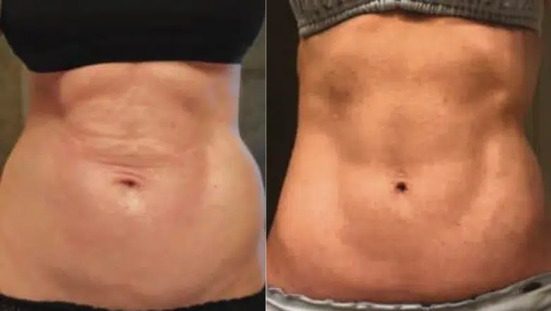 bodytite abdomen before after 2