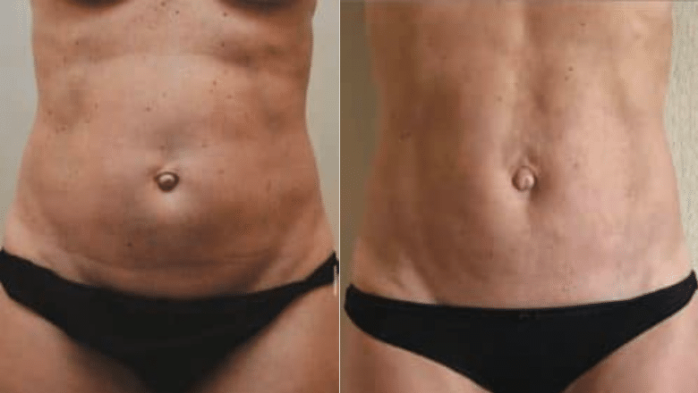 bodytite & Morpheus8 stomach before after