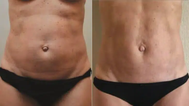 bodytite stomach before after