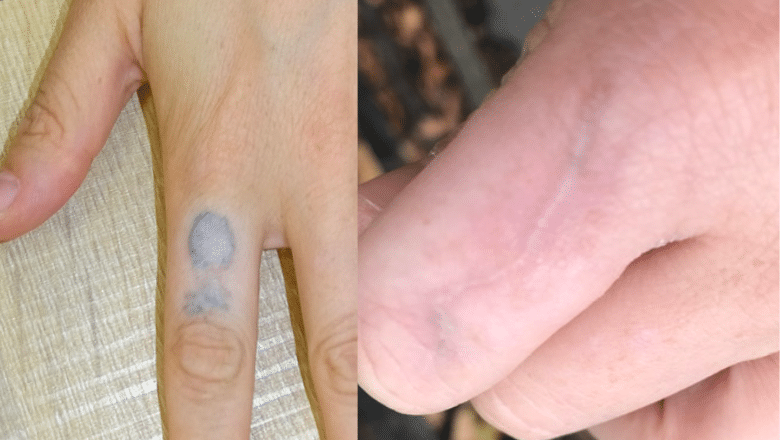 Tattoo Removal How to Costs Before and After Pictures and More