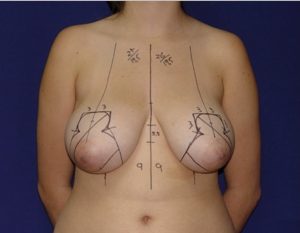 Breast reduction preoperative markings