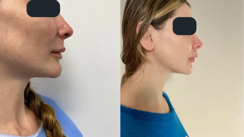 lip lift surgery before after side view