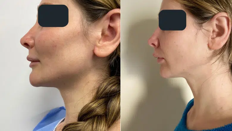 upper lip lift before after side view