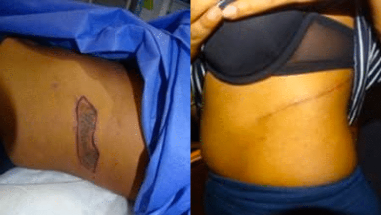 7 Factors that Determine the Cost of Your Tattoo Removal  Tattoo Cares