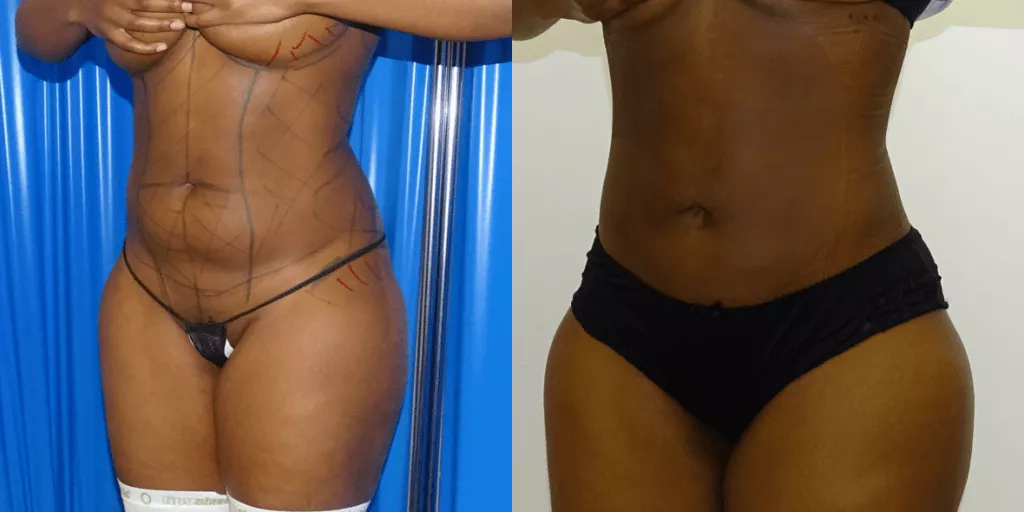 liposuction and bbl before and after