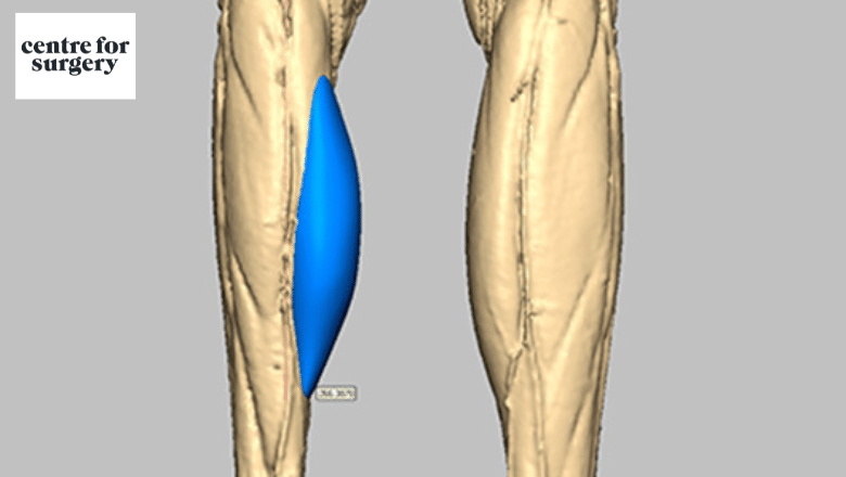 3d scan custom designed calf implant