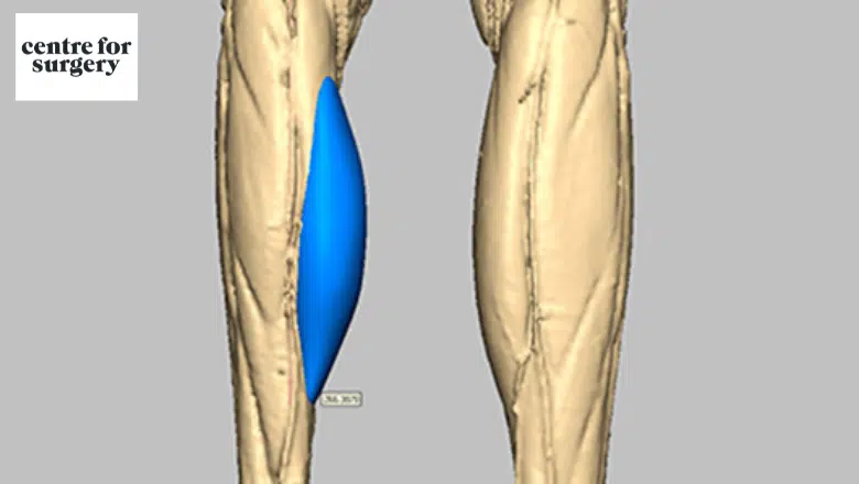 3d scan custom designed calf implant