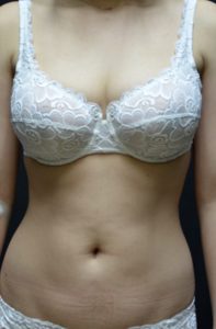 liposuction abdomen before