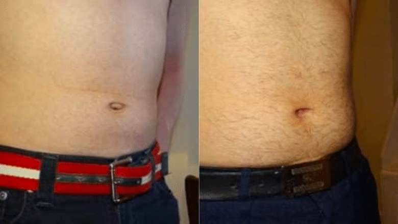 Belly Button Piercing After Tummy Tuck - Instant Loss - Conveniently Cook  Your Way To Weight Loss