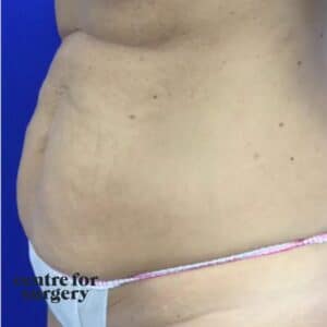 Brazilian Tummy Tuck Before After Centre for Surgery London UK SGL