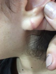 split earlobe repair after