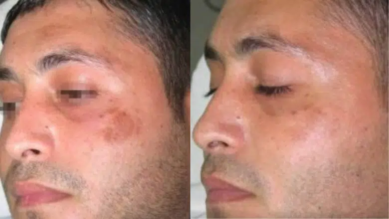 Post-inflammatory hyperpigmentation before after