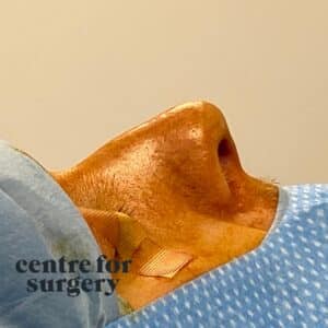 Septorhinoplasty rhinoplasty before after centre for surgery