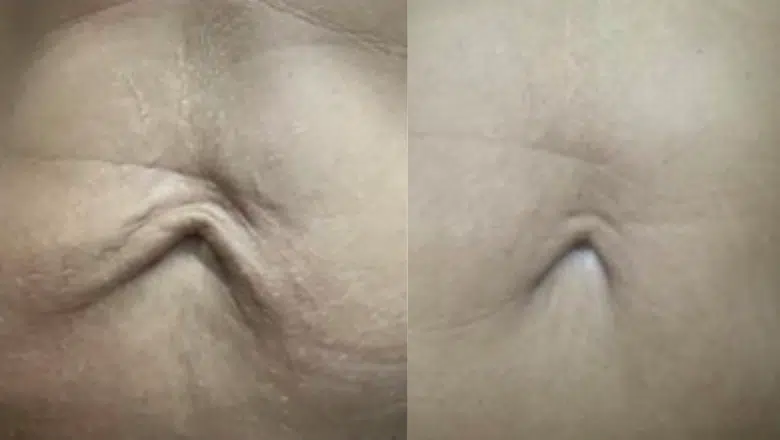 TightSculpting Before & After