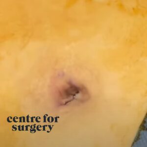 Umbilicoplasty Belly Button Surgery Before After Centre For Surgery London