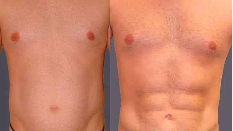 abdominal etching hd lipo before and after 3