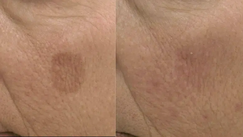 age spot removal before after