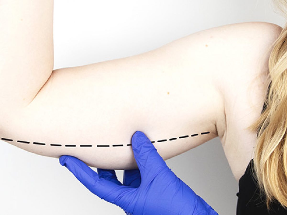 Brachioplasty Arm Lift Procedure Plano TX  Under Arm Flab