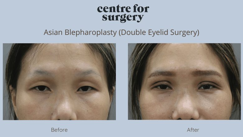 asian blepharoplasty before and after 1
