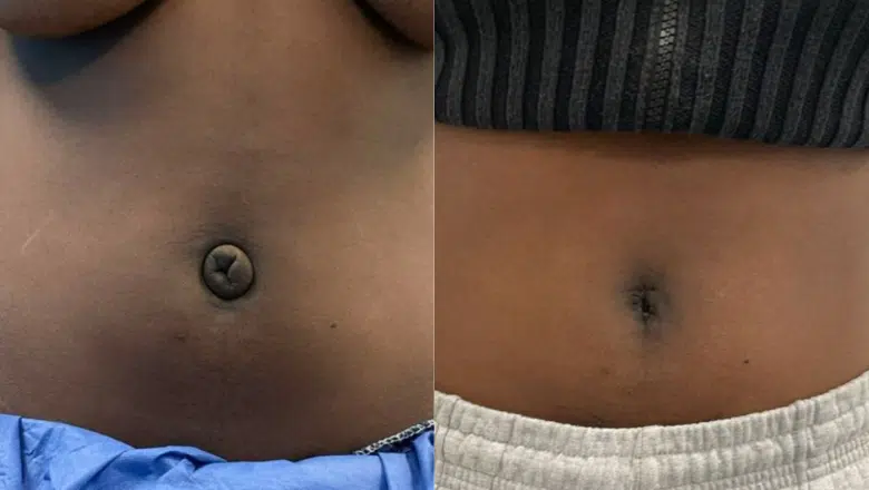 belly button correction before after