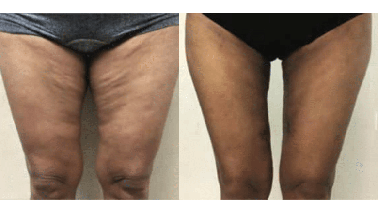 bodytite thighs before after 1