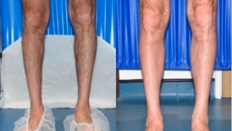 calf implants before after 7
