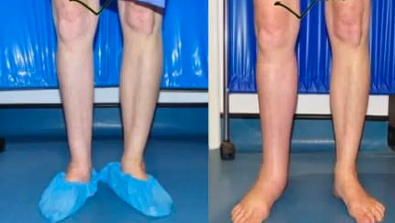 calf implants uk before after 9