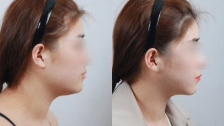 neck lipo before after