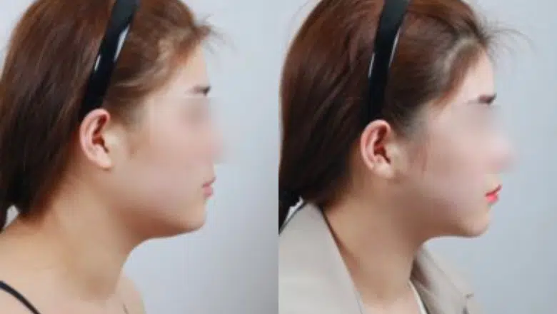 neck lipo before after 