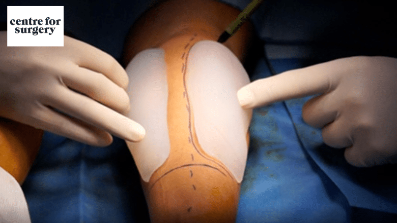 custom calf implant surgery