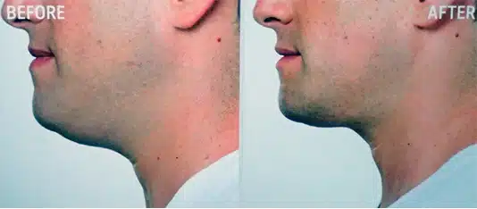 double chin injections before and after profile view male