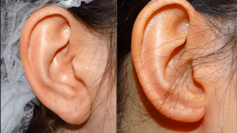 earlobe reduction before after 1