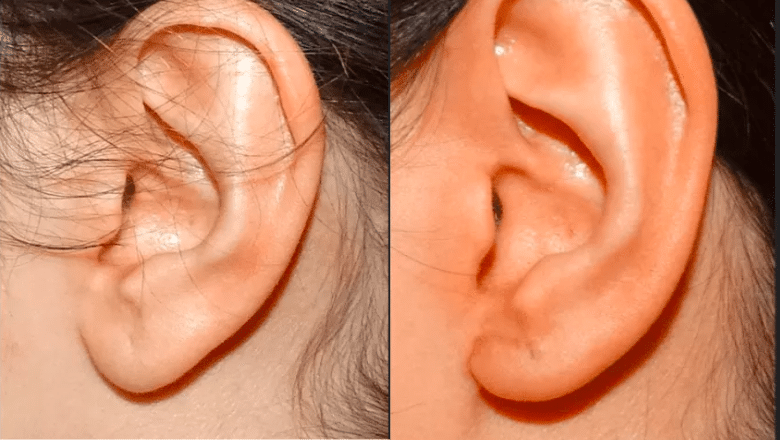 earlobe reduction before after 2