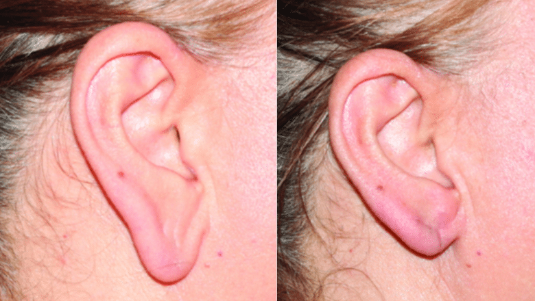 earlobe reduction before and after 3