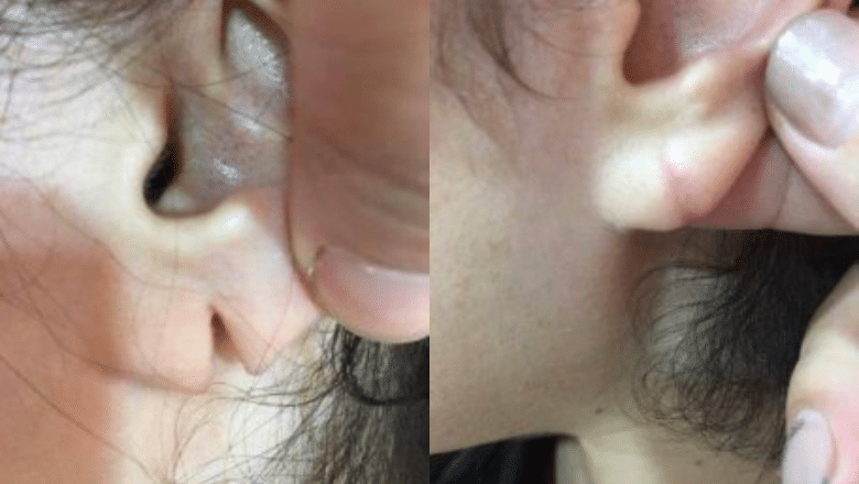earlobe repair before after 1