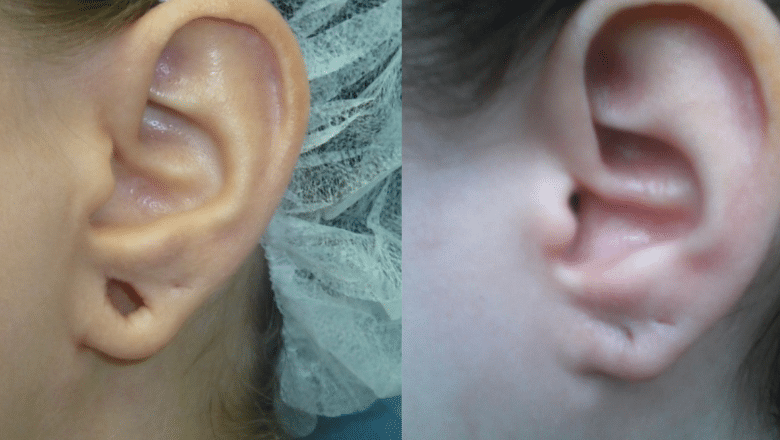 earlobe repair before and after 5