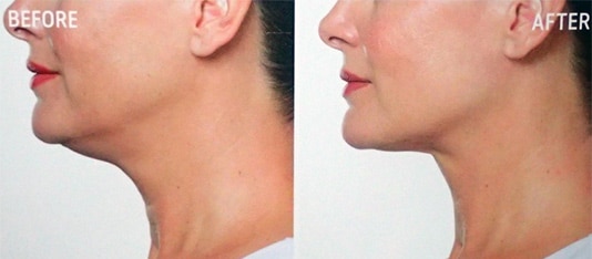 fat dissolving injections before and after profile view female