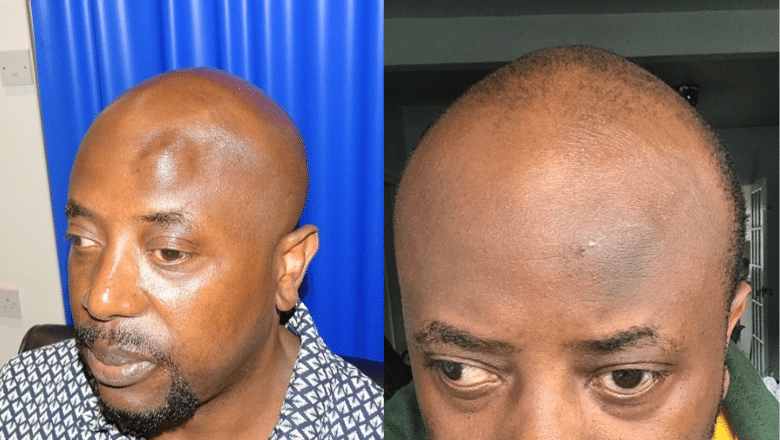 forehead osteoma removal before after 1