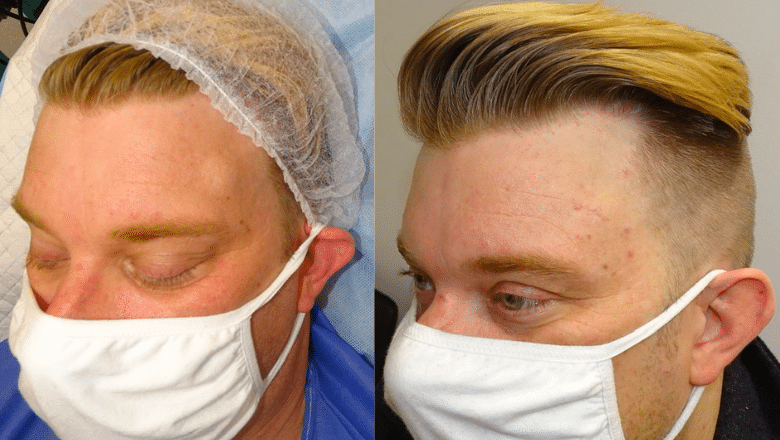 forehead osteoma removal before after 2