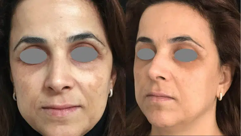 laser melasma treatment before after