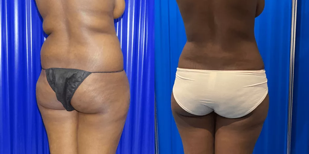 360 liposuction before and after back view
