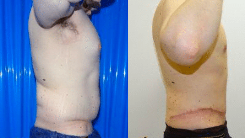 male abdominoplasty side view before after