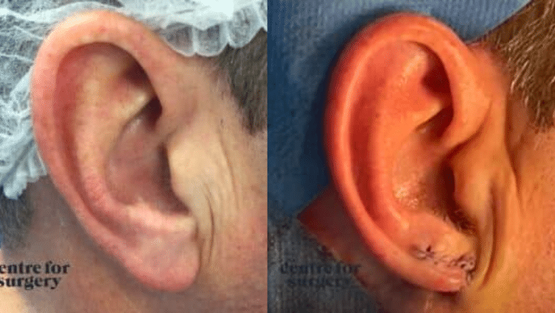 male earlobe reduction before after 2